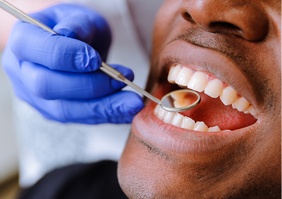Traditional Fillings