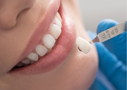 Layered Zirconia or E-max