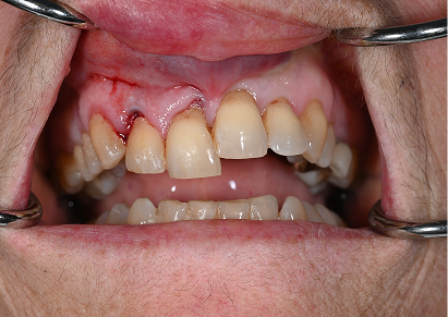 Knocked-Out or Dislodged Teeth