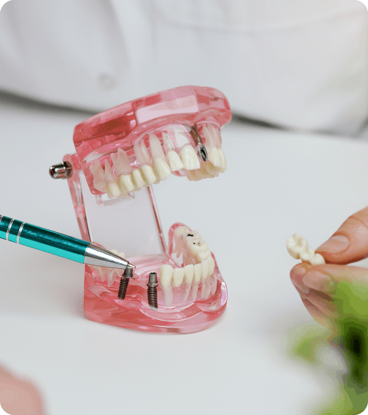 Multiple Teeth Replacement